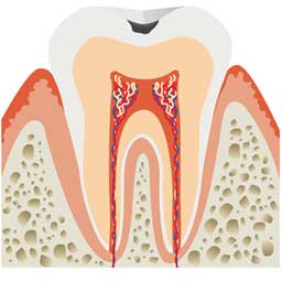 エナメル質に達する虫歯