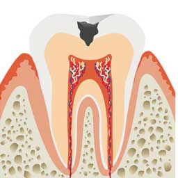 象牙質に達する虫歯