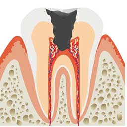 神経に達する虫歯