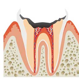 歯根までボロボロになった虫歯