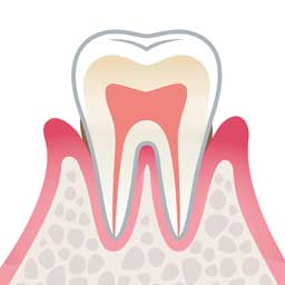 軽度歯周炎