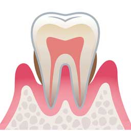 中等度歯周炎
