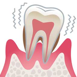 重度歯周炎