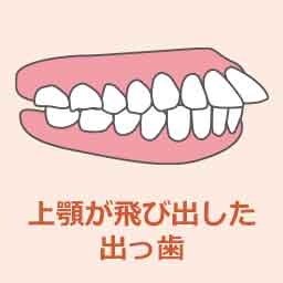 上顎前突