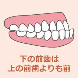 反対咬合