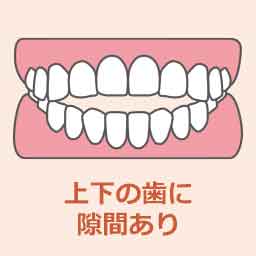 開咬