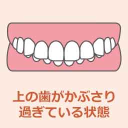 過蓋咬合