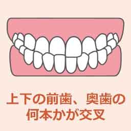 交叉咬合
